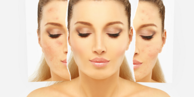 Comment prendre soin de sa peau en cas d'acné, de rosacée ou d'hyperpigmentation  astuces et recommandations (980 x 490 px)
